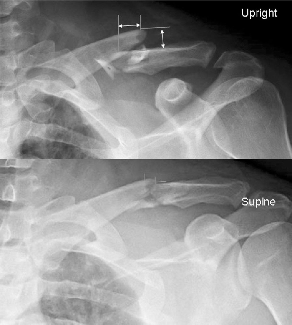 Fractures of the Clavicle Musculoskeletal Key