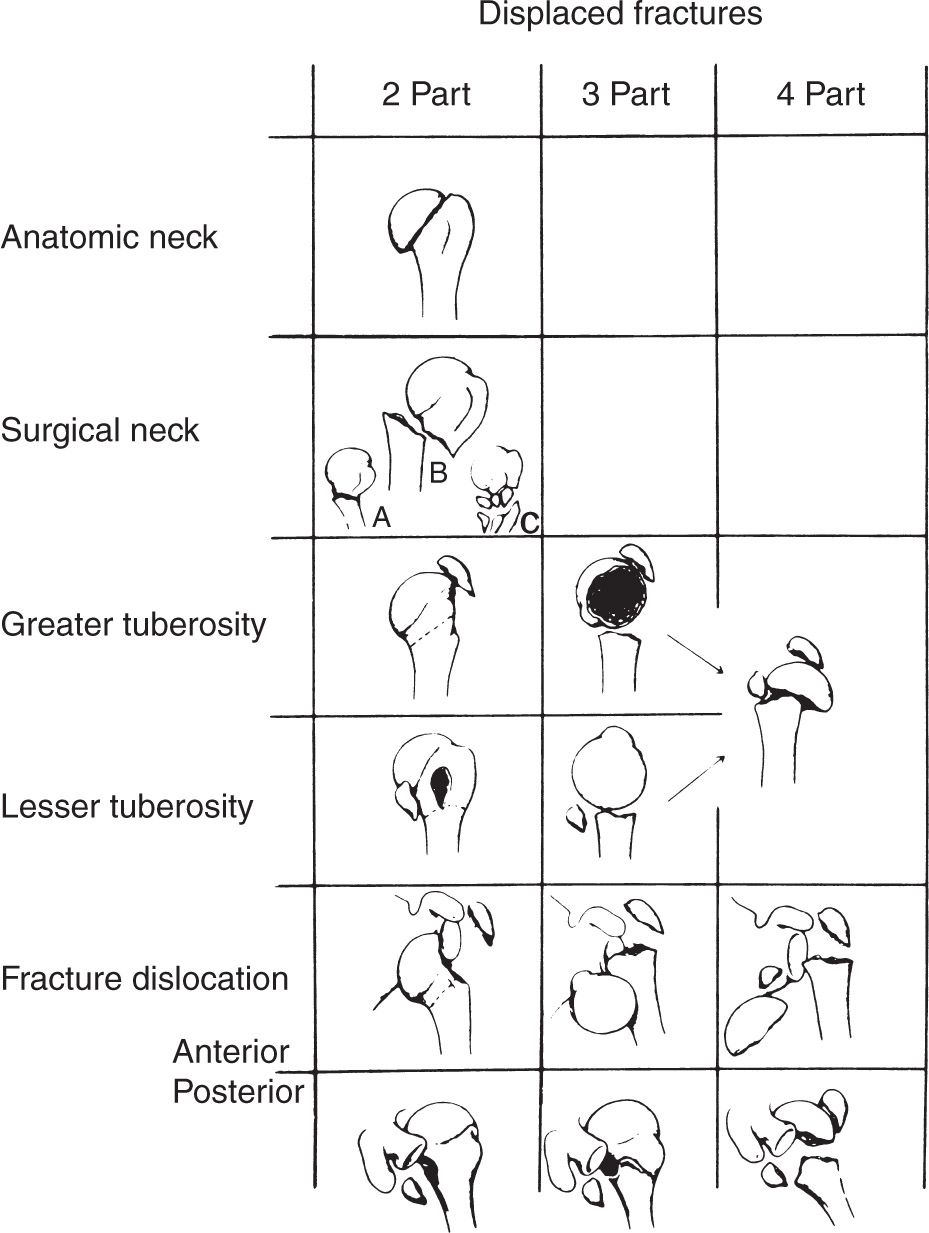 Fractures of the Humerus Musculoskeletal Key