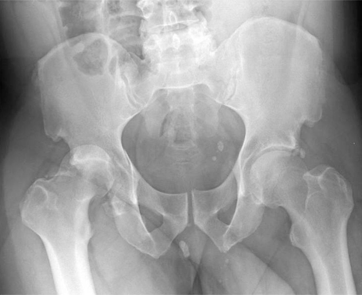 Hip Dislocations, Femoral Head Fractures, and Acetabular Fractures