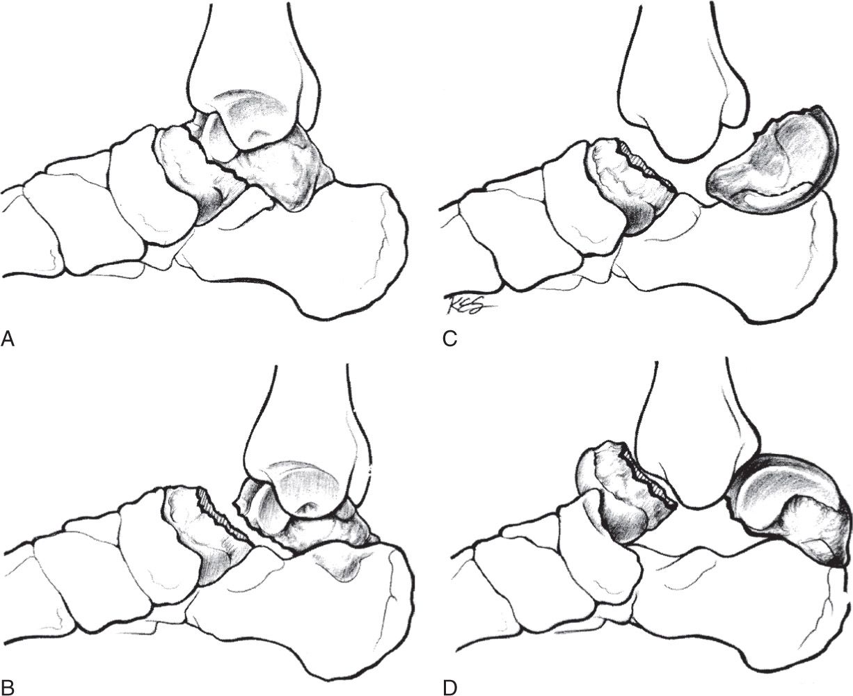 Types Of Talus Fractures