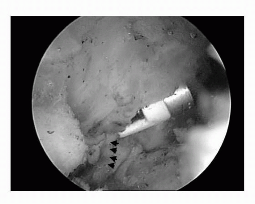 Complications of Arthroscopic Subacromial and