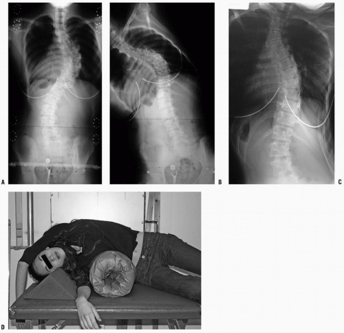 Idiopathic Scoliosis Musculoskeletal Key