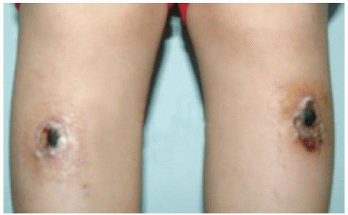 Clinical Practice and Research of Moxibustion Musculoskeletal Key