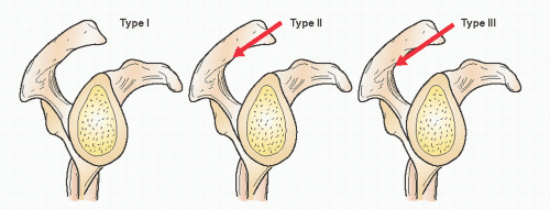 Tendinitis/Bursitis/Subacromial Impingement Musculoskeletal Key