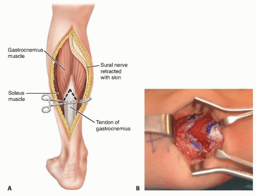 Gastrocnemius muscles diagram