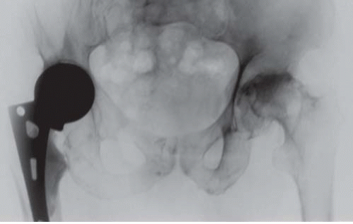 Femoral Neck Fractures Hemiarthroplasty and Total Hip
