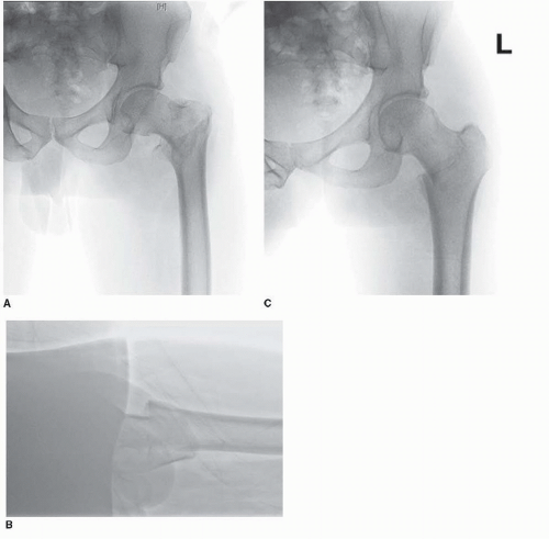 Reverse Obliquity Intertrochanteric Fracture Recovery FRACTURE