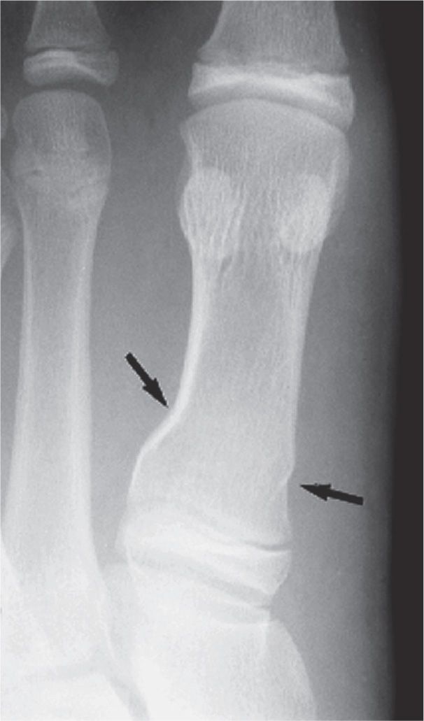 15 Fractures and Related Conditions Fundamentals Musculoskeletal Key
