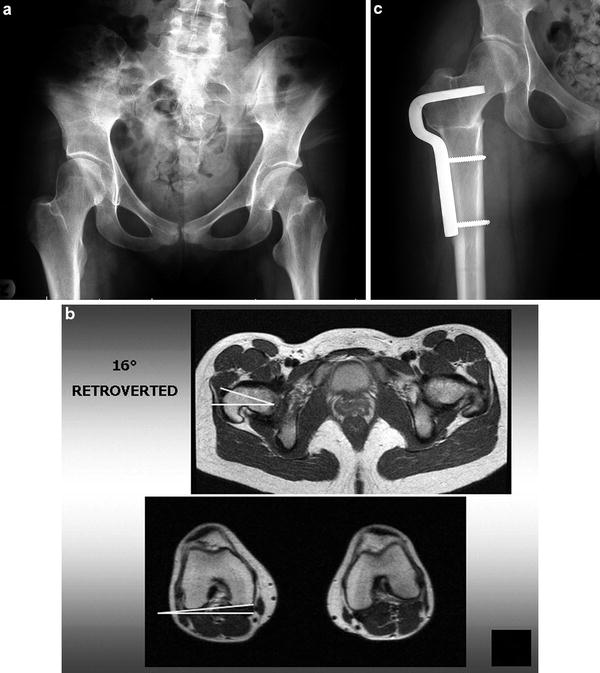 Femoral Deformities Varus, Valgus, Retroversion, and