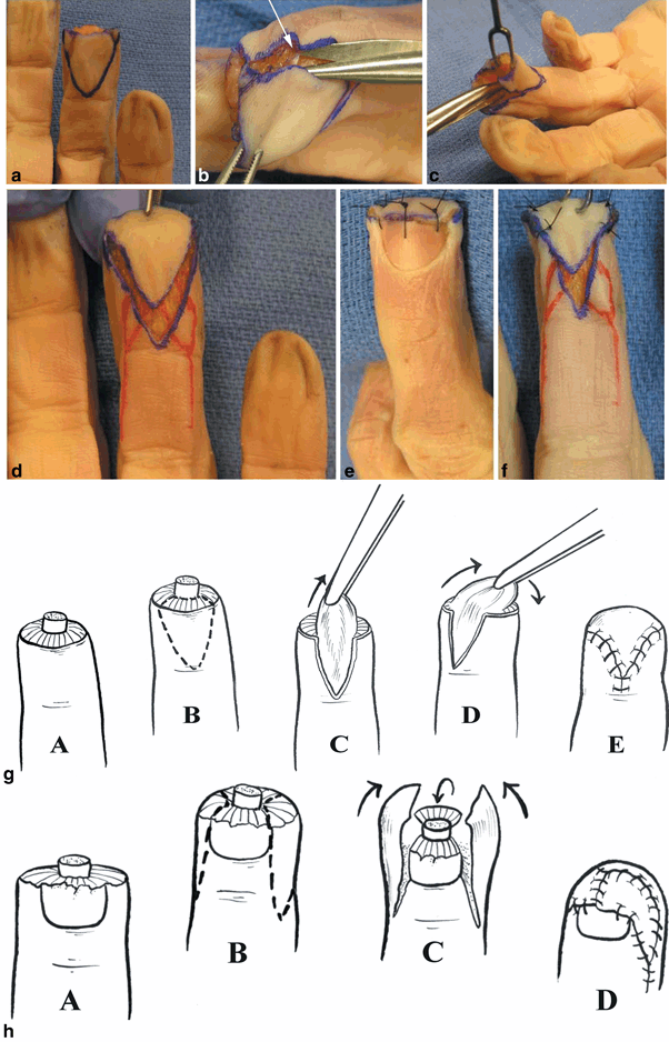 Fingertip Amputations Coverage, Local and Regional Flaps