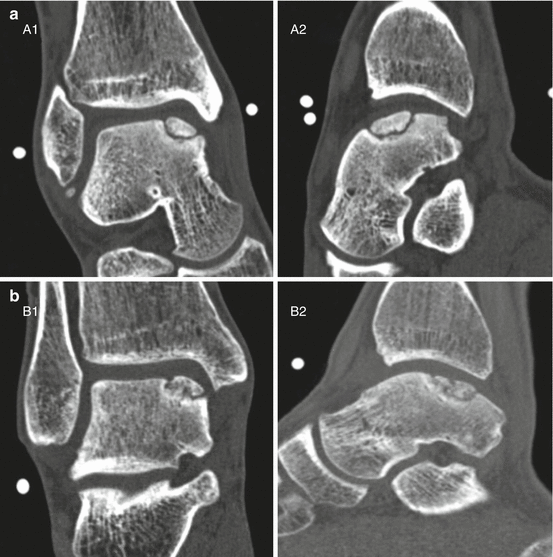 Lift, Drill, Fill and Fix (LDFF) A Cartilage Preservation Technique in Lift, Drill, Fill and Fix (LDFF) A Cartilage Preservation Technique in