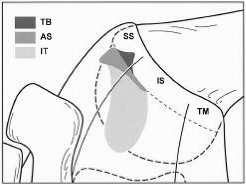 Surgical Treatment of Partial Thickness Rotator Cuff Tears
