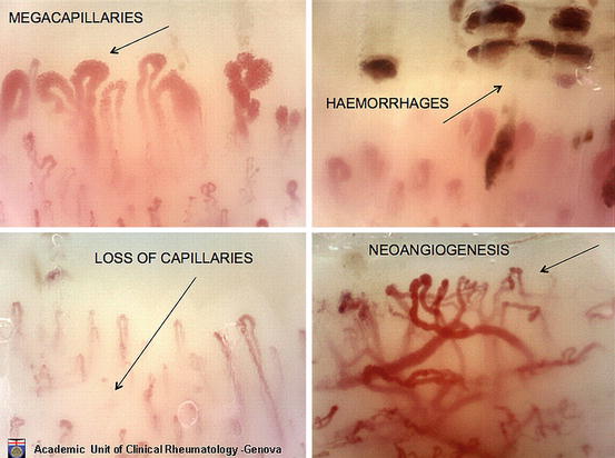 Capillaroscopy Musculoskeletal Key