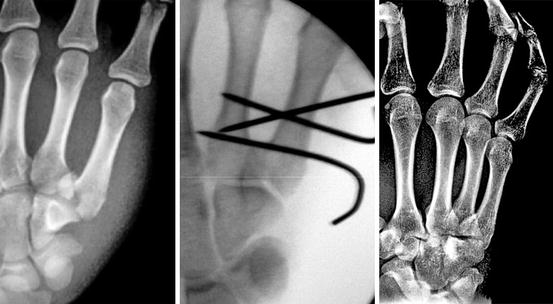 Acute Finger Injuries Musculoskeletal Key