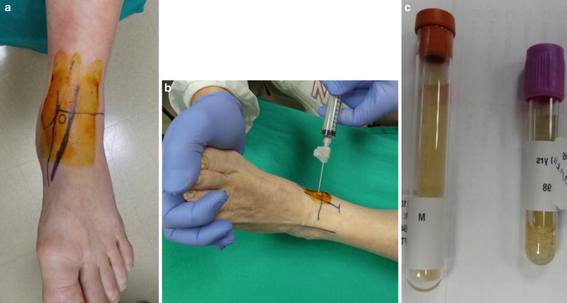 Diagnosis and Management of the Septic Joint