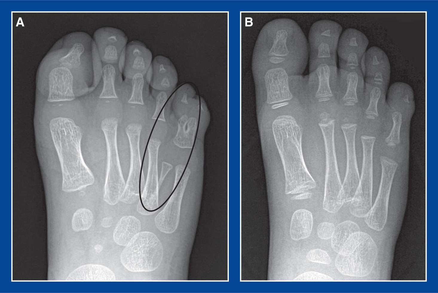 Foot Malformations Musculoskeletal Key