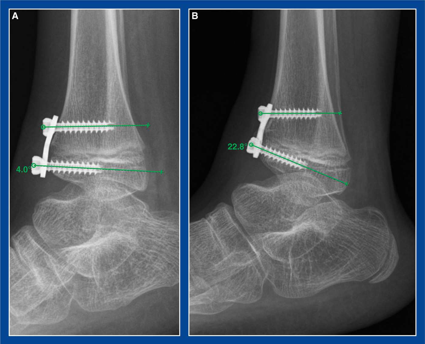 Bone Procedures Musculoskeletal Key