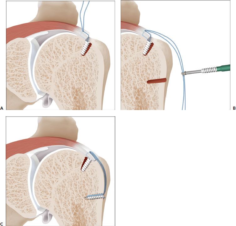Rotator Cuff Cases Musculoskeletal Key