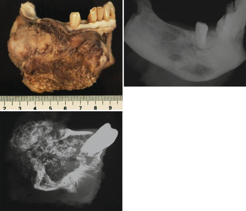 Bone Tumors: A Practical Guide to Imaging Request PDF Research…