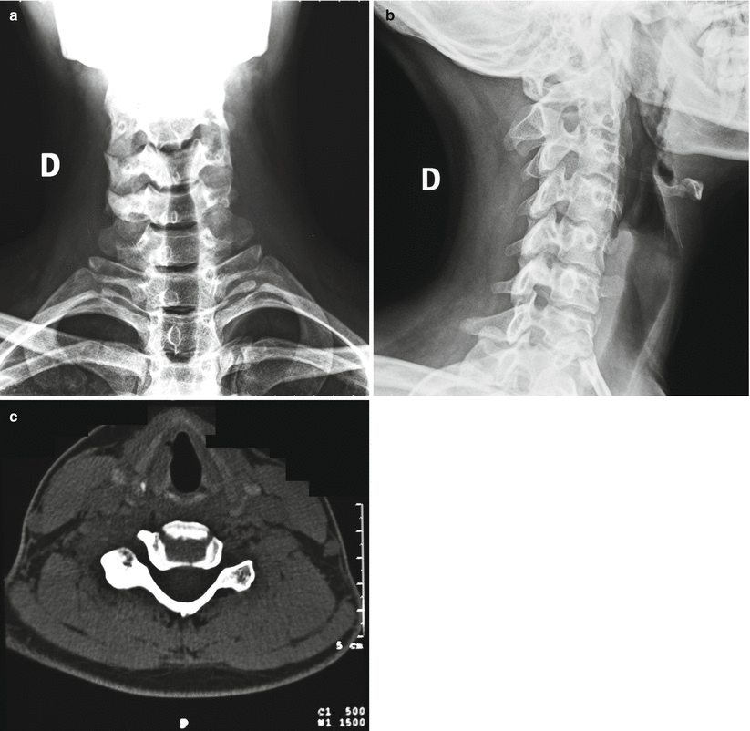 Bone Tumors: A Practical Guide to Imaging SpringerLink