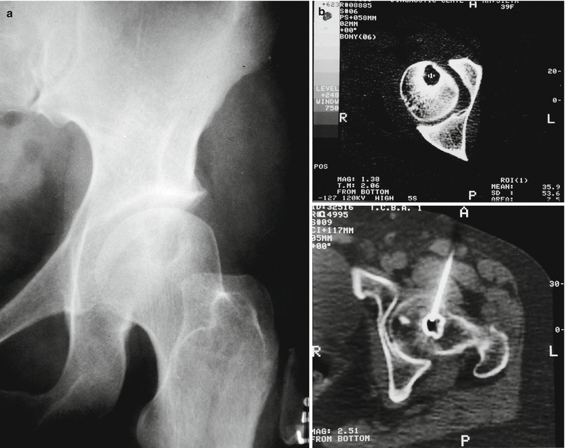 Juxtaarticular Bone Cyst Musculoskeletal Key