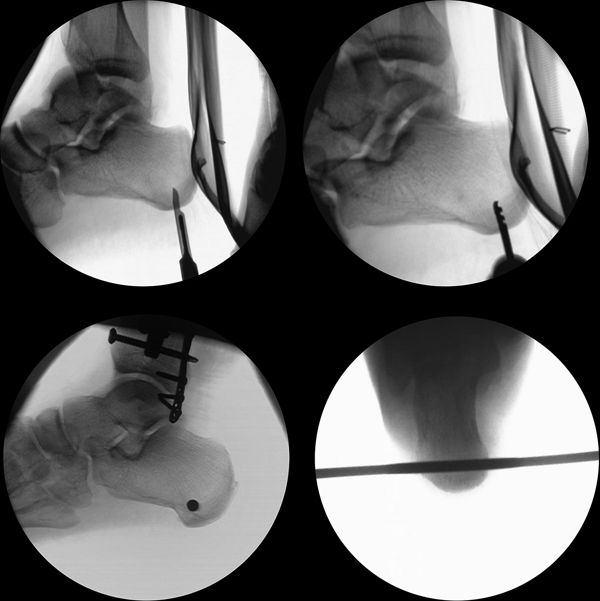 AnkleSpanning External Fixation Musculoskeletal Key