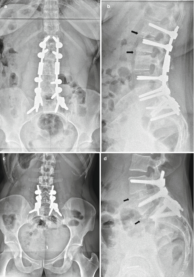 Oblique Lumbar Interbody Fusion Musculoskeletal Key