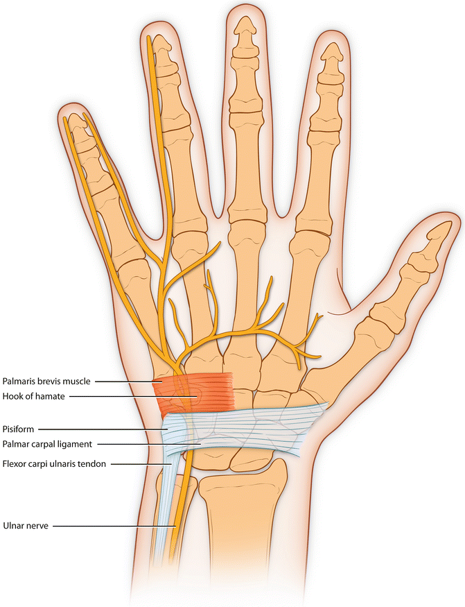 Ulnar Tunnel Syndrome Musculoskeletal Key