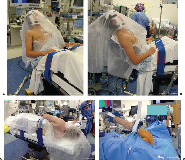 Humeral Shaft and Proximal Humerus, Shoulder Dislocation Humeral Shaft and Proximal Humerus, Shoulder Dislocation