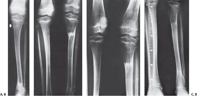Fractures of the Shaft of the Tibia and Fibula | Musculoskeletal Key