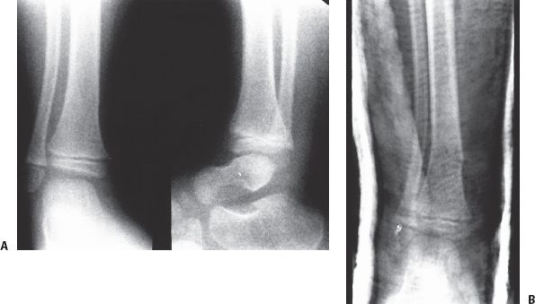 Fractures of the Shaft of the Tibia and Fibula | Musculoskeletal Key