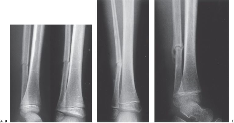 Fractures of the Shaft of the Tibia and Fibula | Musculoskeletal Key