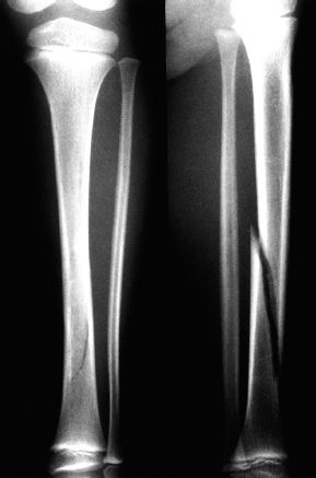 Fractures of the Shaft of the Tibia and Fibula | Musculoskeletal Key