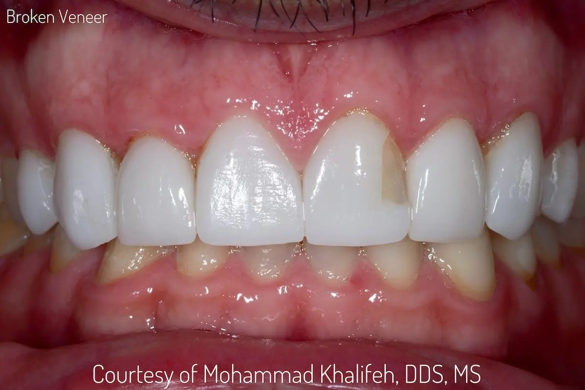 Same Day Crowns & Veneers Museum Dental Center 5757 Wilshire Blvd