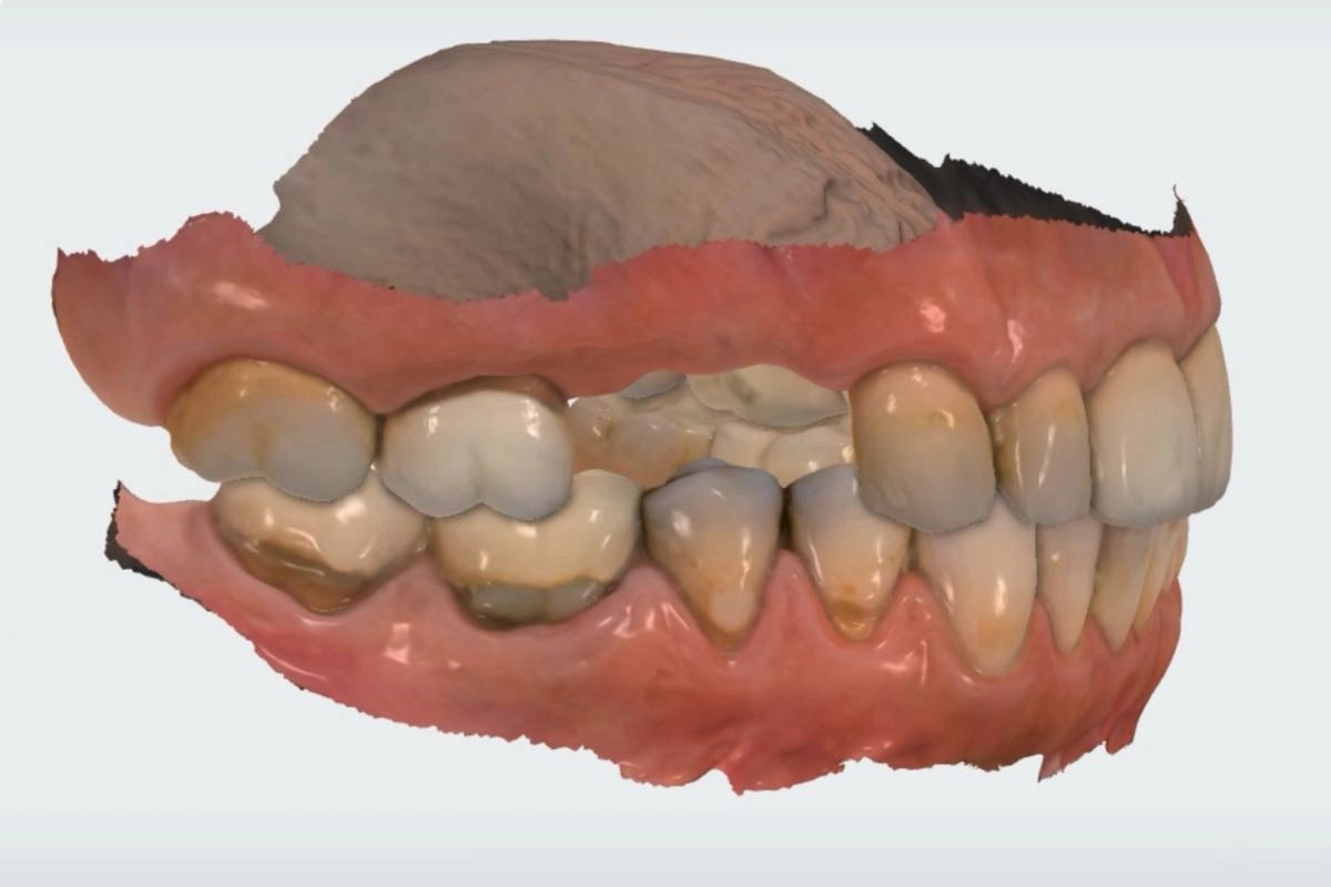 Dental Implants Specialist Los Angeles, Ca Museum dental Center