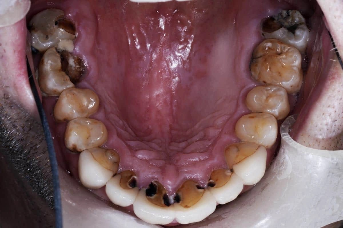 Are Rotten Teeth Dangerous? Museum Dental Center Los Angeles, CA