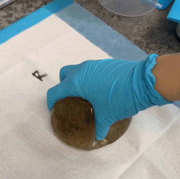 Woman Removes Breast Implants After Suffering Mysterious Ailments