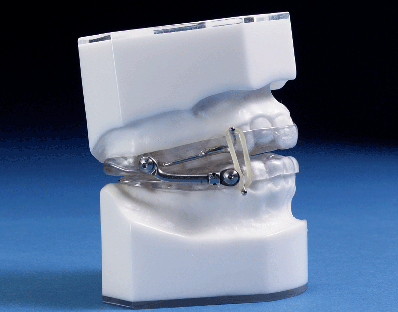 Oral Appliances An Experienced Dentist Shares Her Perspective MyApnea