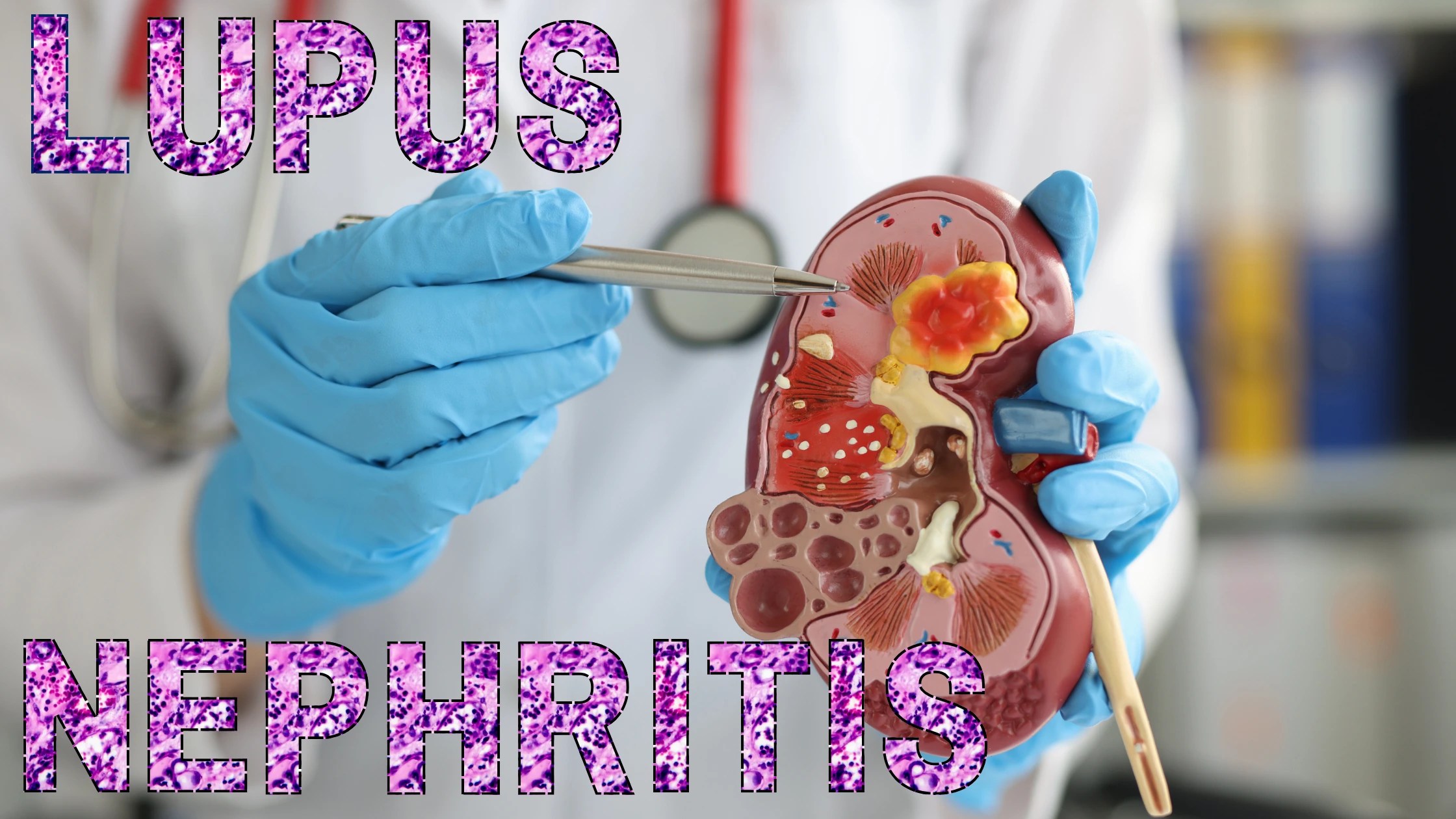 Exploring the Essentials 7 Vital Questions Regarding Lupus Nephritis