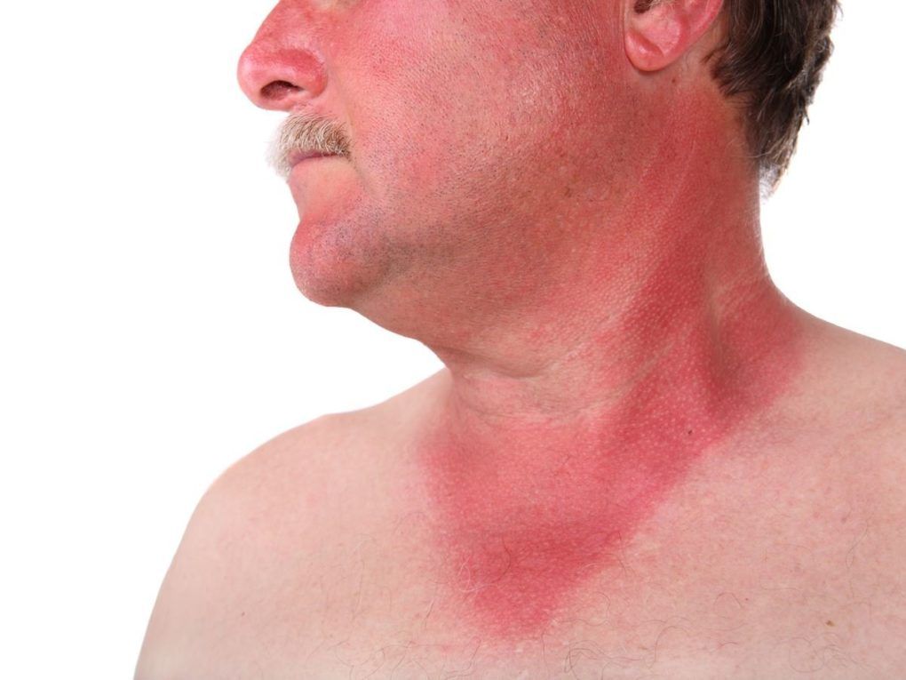 Sunburns (Photo Credit Organic Facts) Backyard Tour