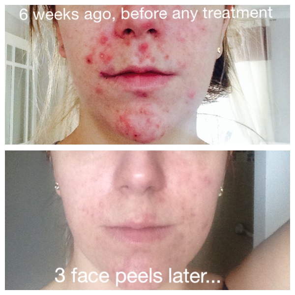 Acne Safe and Effective Treatments for Acne in Peterborough