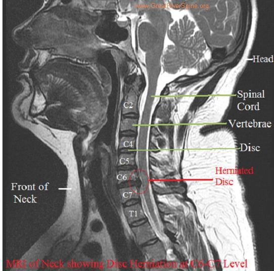 Help, I think I have a pinched nerve in my neck! Beyond Wellness