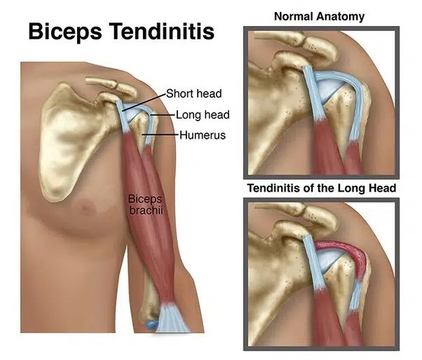 Biceps Tendonitis Oriental Medical Doctor Beyond Wellness