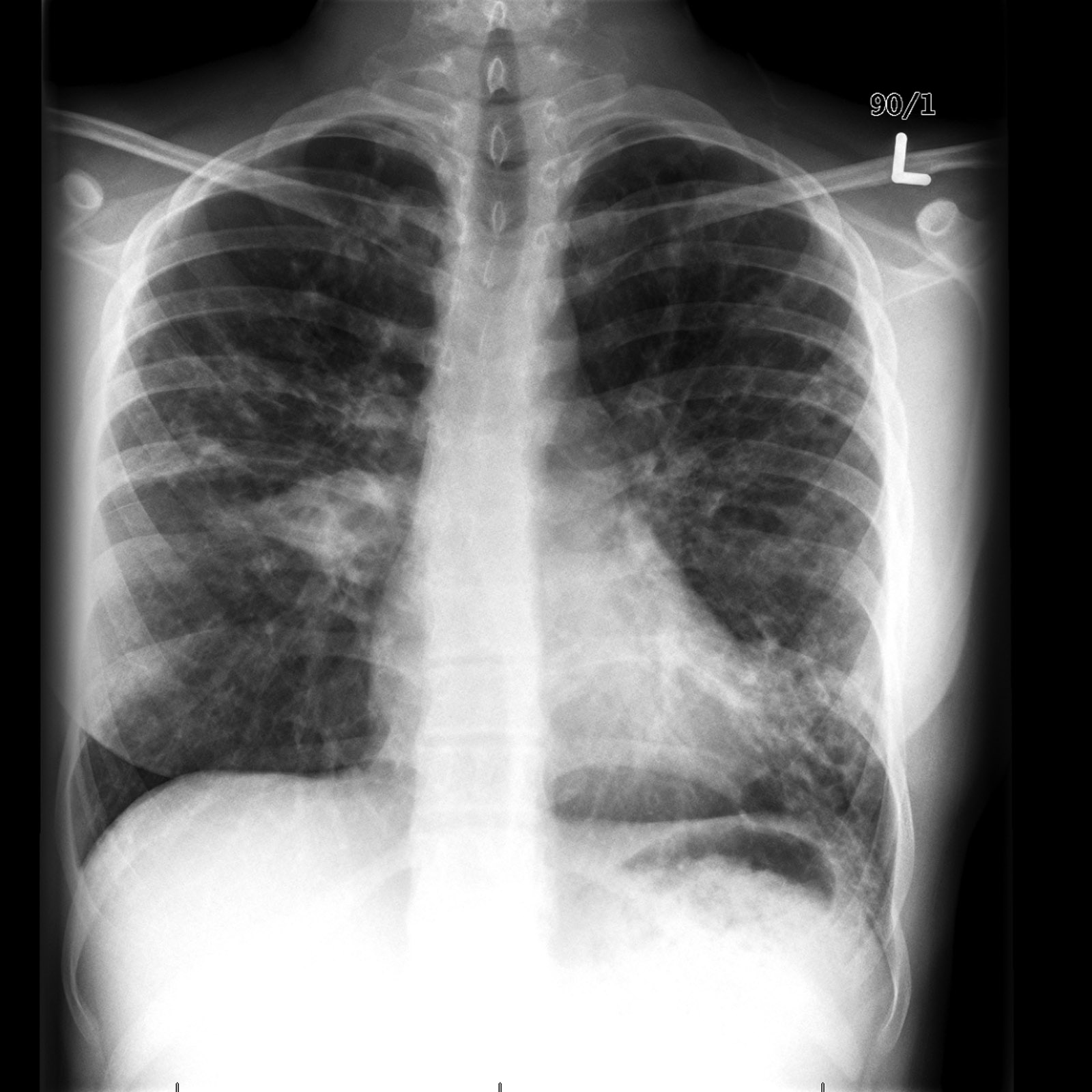 CXR and CT scans