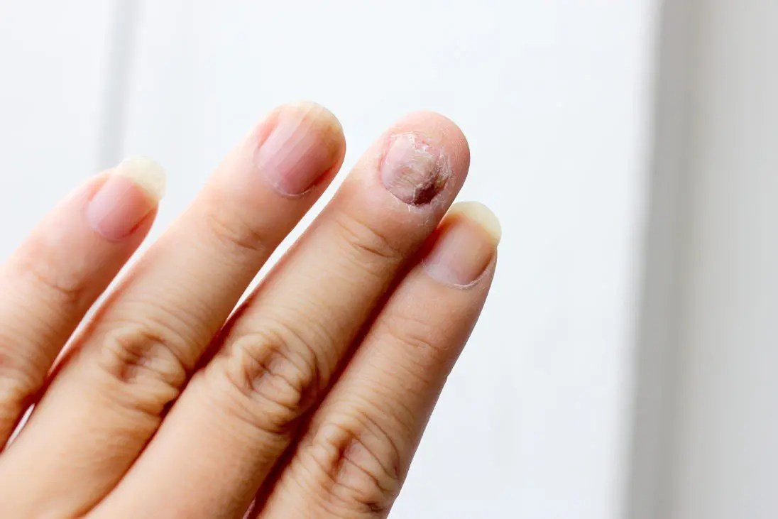 14 Home Remedies for Nail Fungus Plus Bonus Remedy