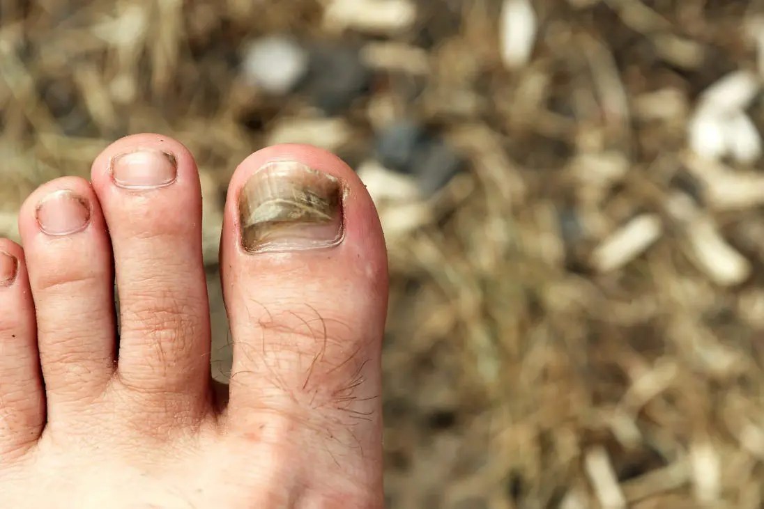 Black Toenail FIND Out More About YOUR Black Toenail TODAY!!