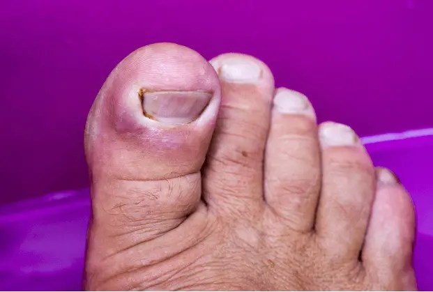 Toenail Fungus How Exactly Do You Get Rid of It?