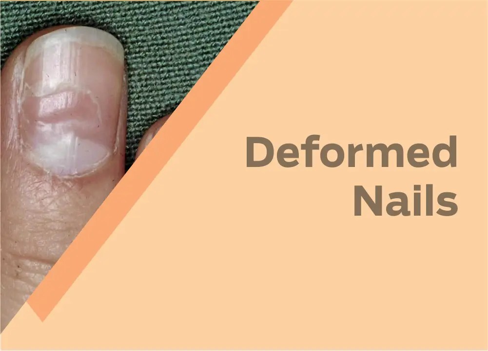 Toenail Problems My Clean Nails