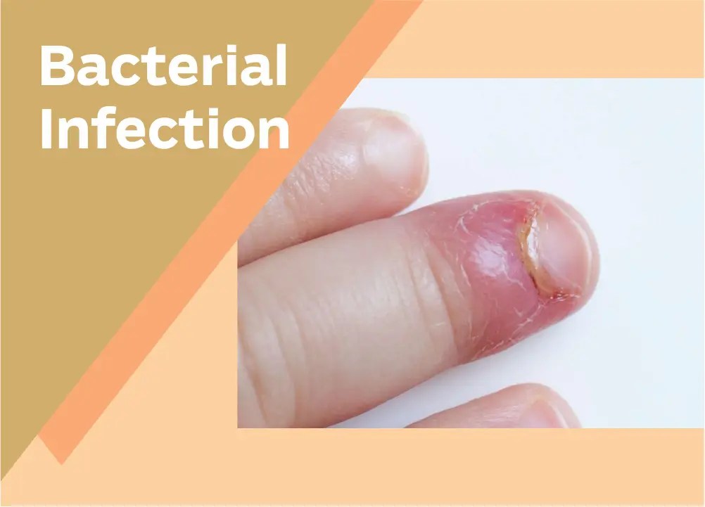 Toenail Problems My Clean Nails