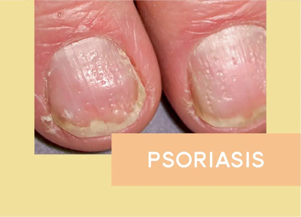 This Is How To Soften Your Toenails My Clean Nails